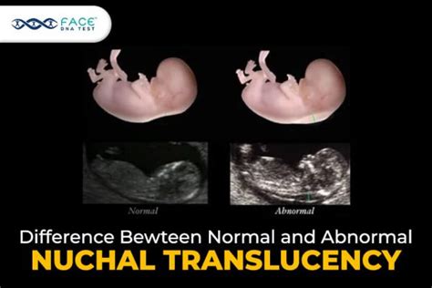 what is normal nuchal translucency